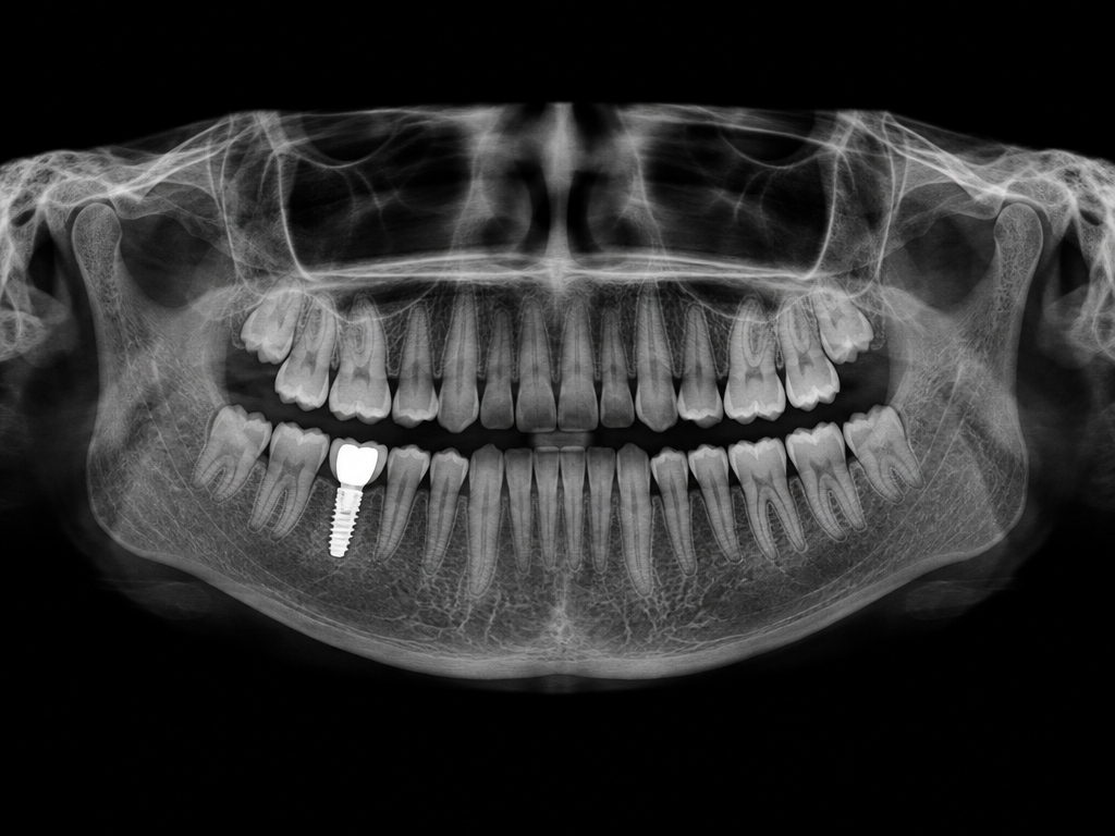 Panorama-Röntgen auf schwarzem Grund, ein Implantat im Unterkiefer